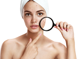 Melasma
